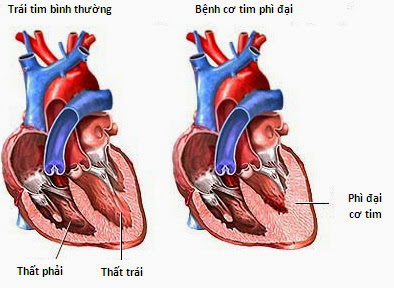 Các bệnh tim mạch dẫn tới suy tim